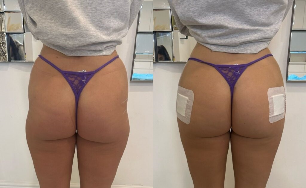 What Are Hydrogel Butt Injections